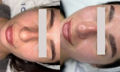 Уход Couperose therapy от  REVIDERM